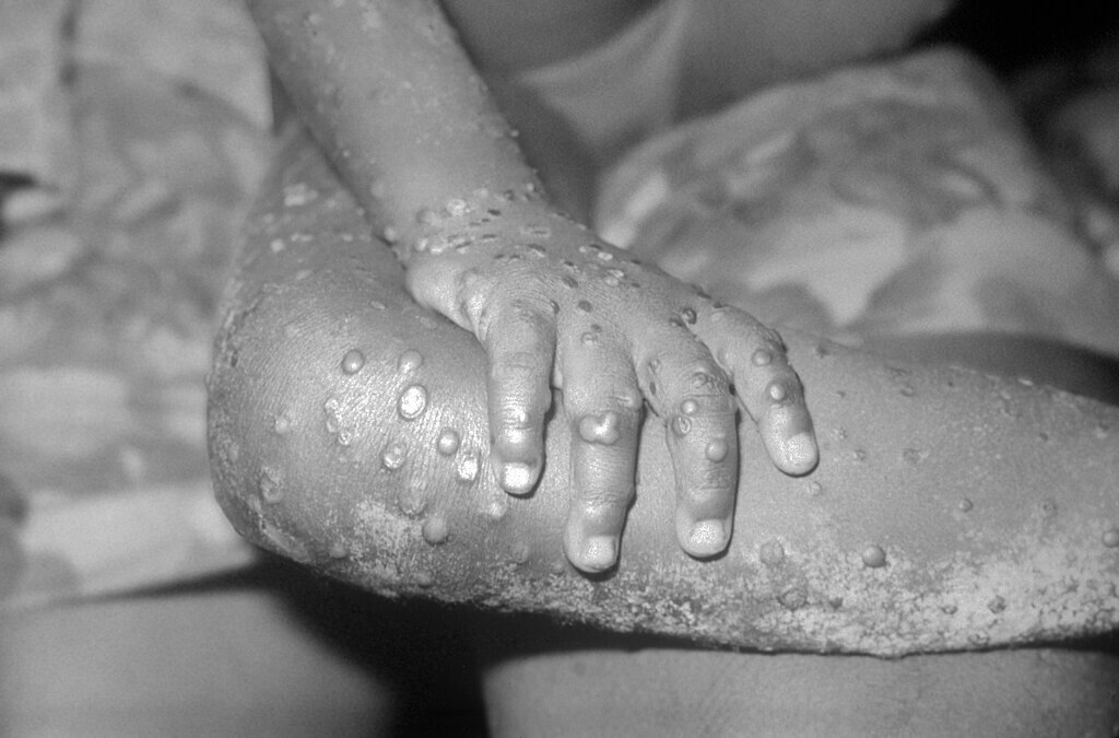 Young child with monkey pox