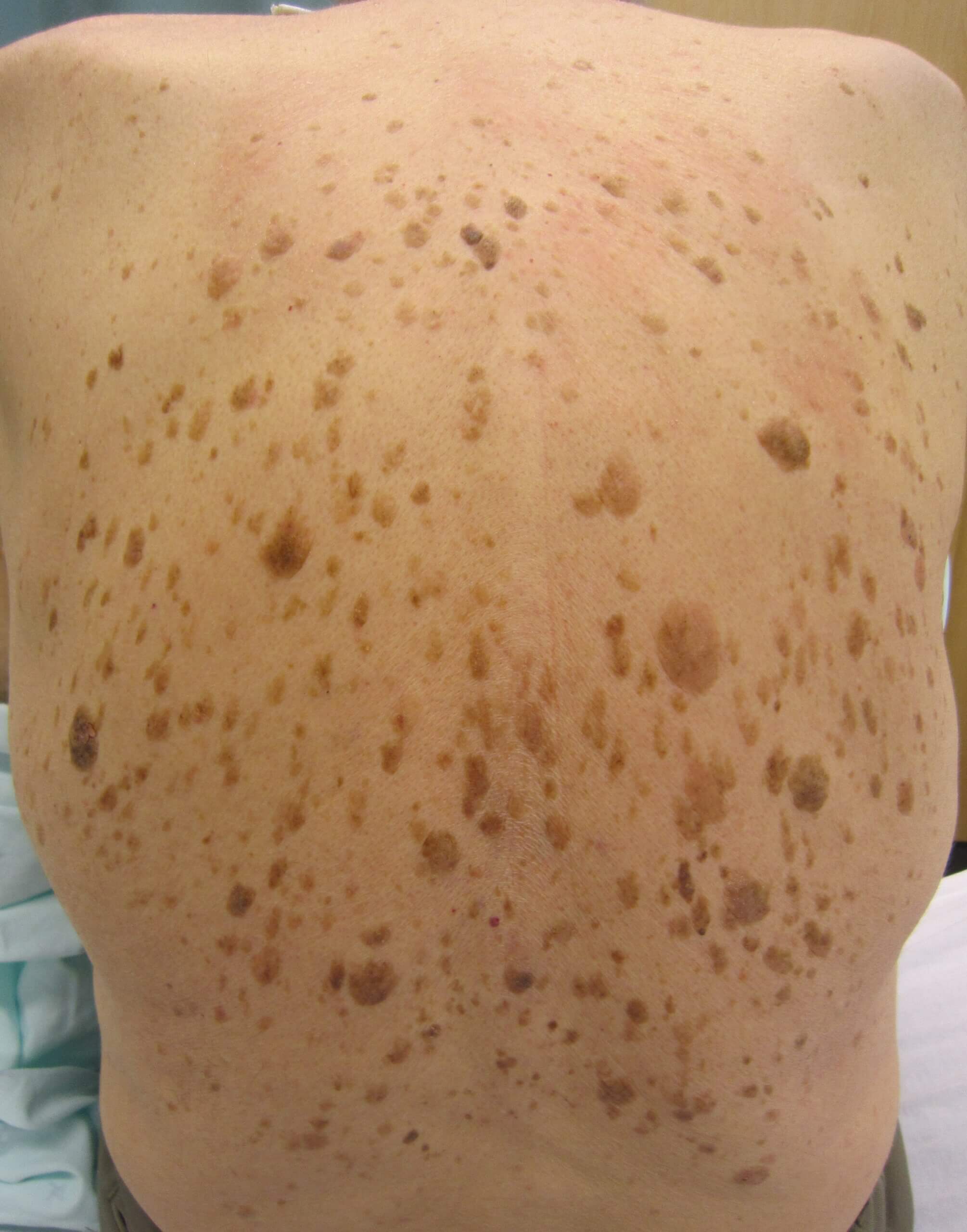 A person's back who has Seborrheic Keratosis