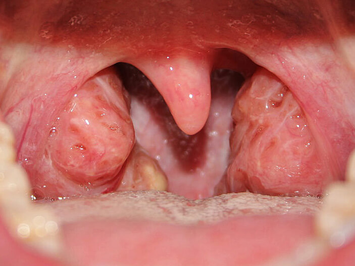 A photograph of an open mouth showing the tonsils and uvela.