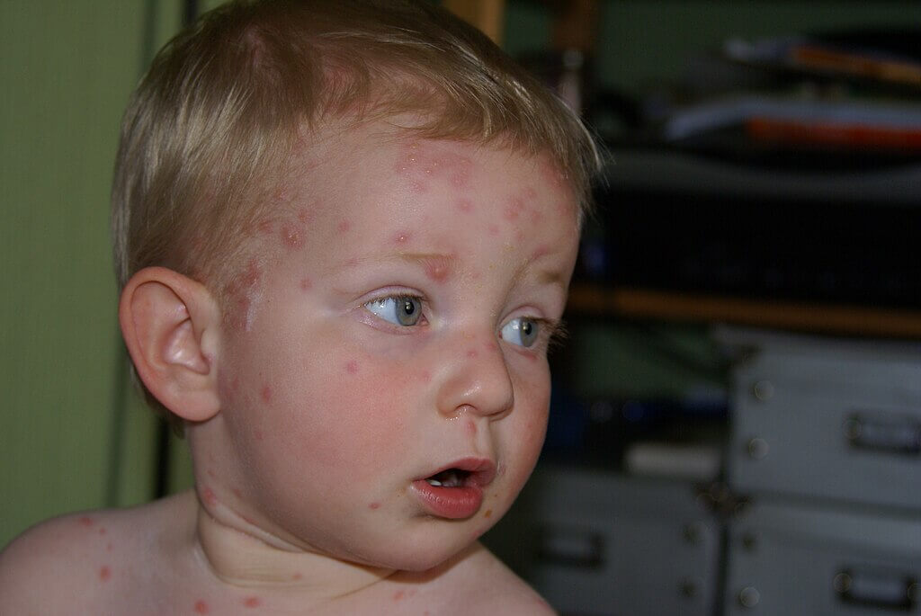 A young boy's face covered in spots from the chickenpox virus