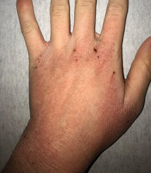 Dry skin and Eczema