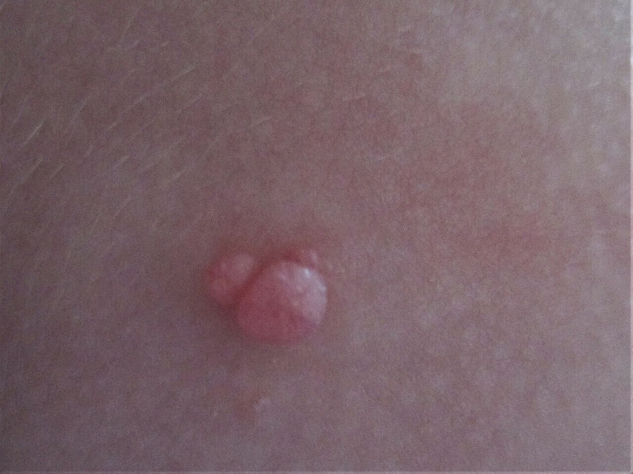 Molluscum contagiosum red spot on skin