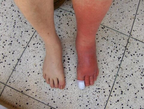 Photo of the legs of a person, one leg being very swollen and red because of cellulitis.
